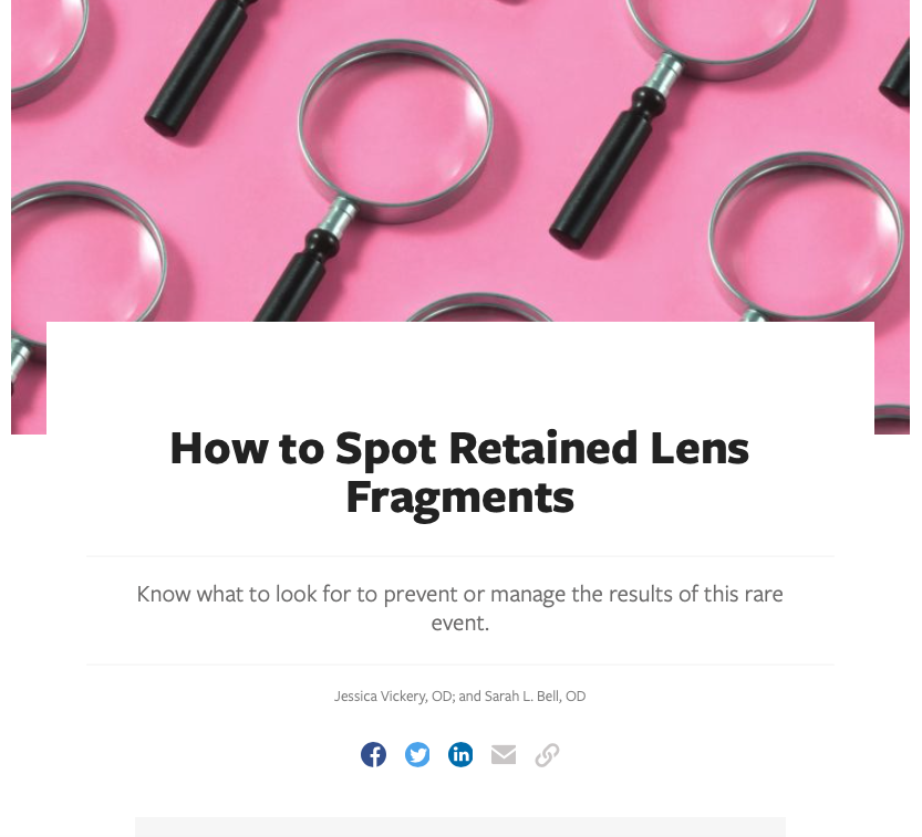 Retained lens fragments occur in approximately 0.3% to 1.1% of cataract surgeries. Read how to find and remove these complications: hubs.ly/H0lcWXb0 #optometry #Cataract #CataractSurgery #comanagement