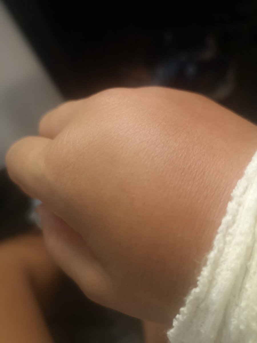 Ali30sj's tweet photo. Durante mi viaje en Filipinas me pico un insecto y este fue el resultado la compañía @FiactSegurAlcal no han considerado suficiente los informes médicos aportados por considerarlo insuficientes, NUNCA CONTRATÉIS ESTA COMPAÑÍA PARA ASISTENCIA MÉDICA EN VIAJES https://t.co/NBNyavPEBp