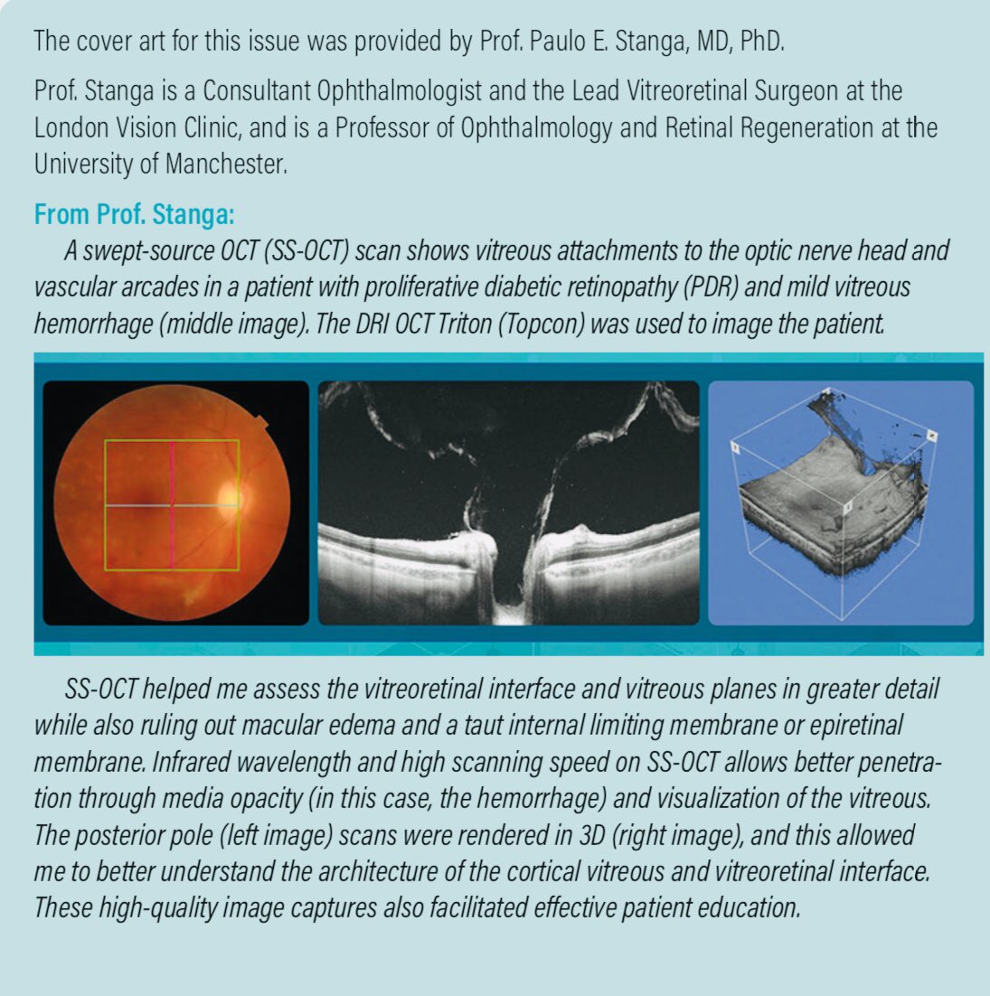 ProfStanga's tweet photo. Images from our work @LondonVision using the most advanced #Sweptsource #OCT #imaging technology to visualise the #vitreous and the #retina in #diabetic #retinopathy has been featured last month on the cover of @RetinaToday #Early #Diagnosis https://t.co/mAMj3ubTzG