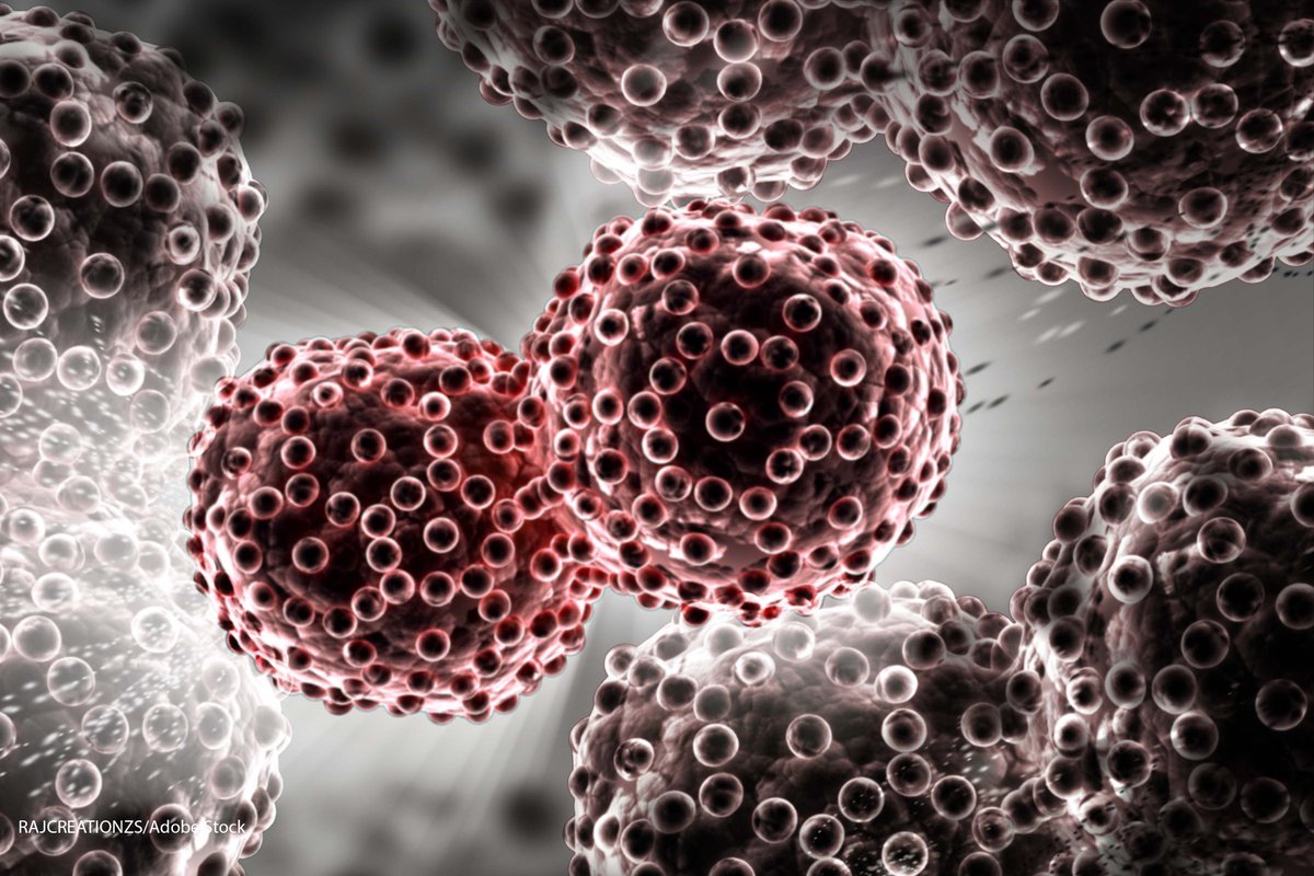 CancerNetwrk's tweet photo. From @IASLC: One-third of patients with locally advanced non-small cell #lungcancer treated with durvalumab developed symptomatic pneumonitis. #NACLC19
https://t.co/vPMUkXf6VN https://t.co/tZ5NZBzk97
