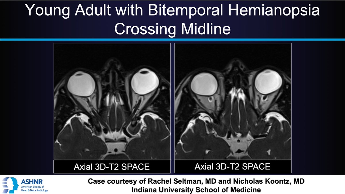 ASHNRSociety's tweet photo. #ASHNRCOTW #77: Young adult, bitemporal hemianopsia crossing midline. Dx? Thx Drs. Seltman &amp; @nakoontz @IURadiology 4 case! #ASHNR20

Answer w/ appropriate GIF only -- stay professional &amp; don't spoil it!

@callyrobs @DShatzkes @rhwiggins @CDP_Rad @cmtomblinson @TheASNR @RadRupa https://t.co/lhsQv9o2Rh