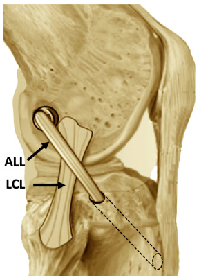 Combined Reconstruction of the Anterolateral Ligament in Patients With Anterior Cruciate Ligament Injury and Ligamentous Hyperlaxity Leads to Better Clinical Stability and a Lower Failure Rate Than Isolated Anterior Cruciate Ligament Reconstruction
arthroscopyjournal.org/article/S0749-…