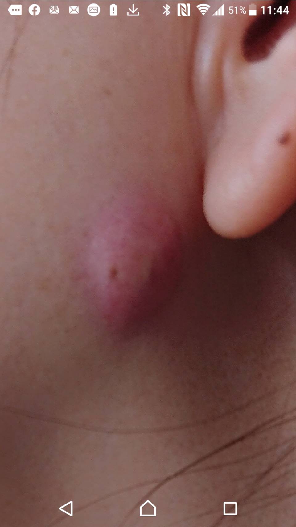 O Xrhsths 森田皮膚科 Sto Twitter 粉瘤 が化膿してます レーザーで2ｍｍの穴をあけて 膿とお粥みたいな排泄物を出します メスで切開するよりも 後々の皮膚の仕上がりが きれい ですから T Co Xhqxm7nsyi Twitter