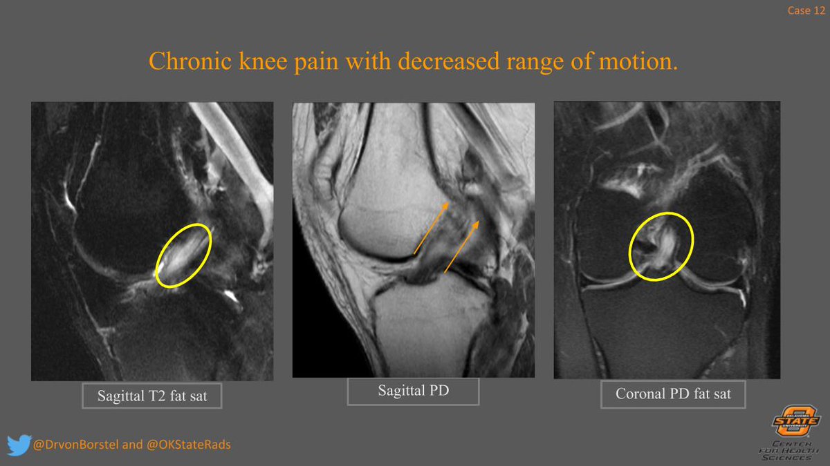 DrvonBorstel's tweet photo. Answer for this weeks case: Mucoid degeneration of the ACL
Best GIF answer for this case to @RadioGyan! #osuchs #MSK #RadRes #FOAMrad #FOAMed #celerystalk #ACL https://t.co/tJvZnuwqa6