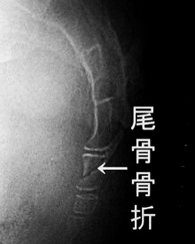 骨折 尾てい骨