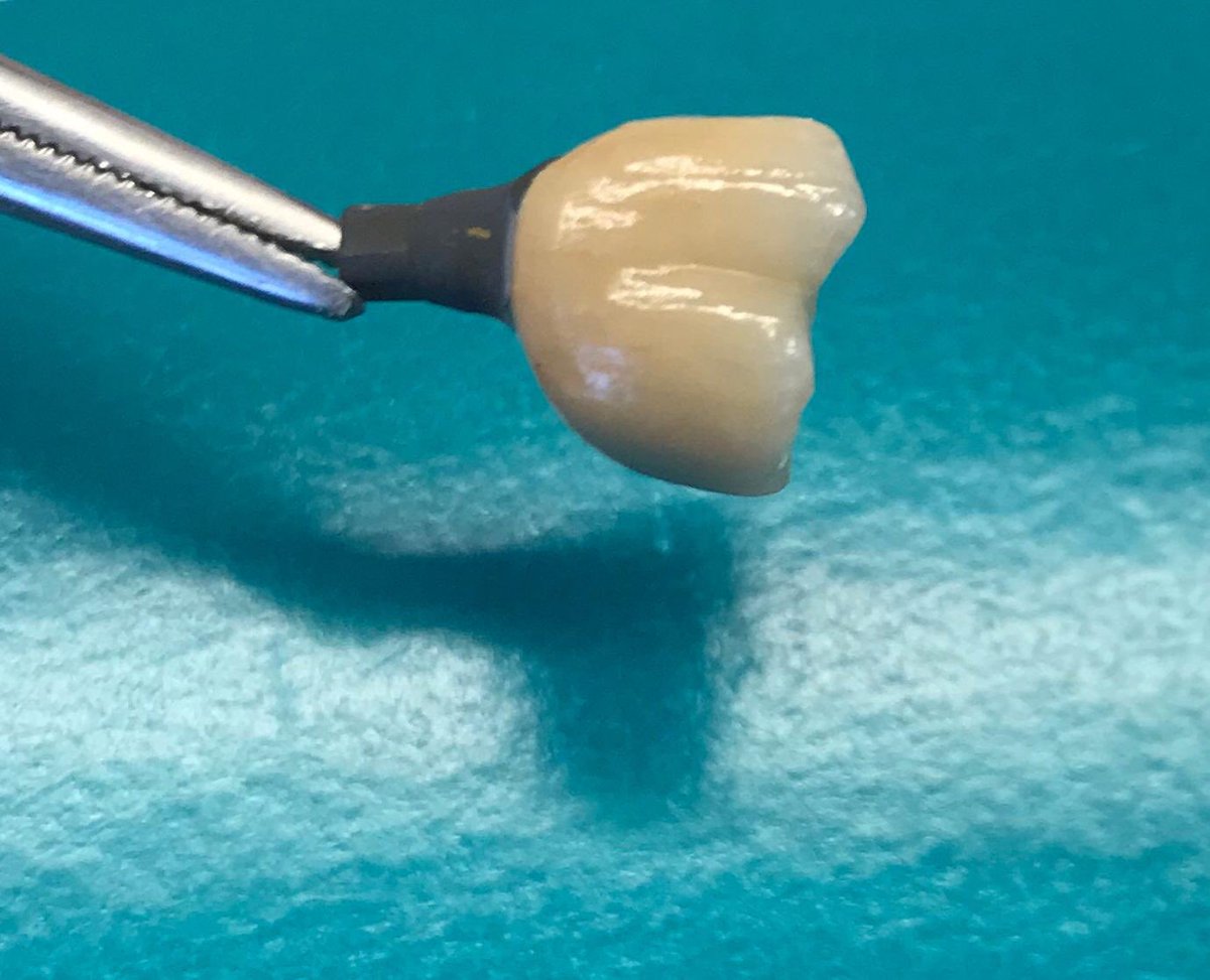 #atlantis 
#Titanium
#GC 
#Initial
#TI
#GCInitialTI
#Restorative
#Implant                                                   #implantdentist                                      #implantdentistry                                  #smileagain <a href="/optimum_dental/">Optimum Dental Lab</a> #loyalty