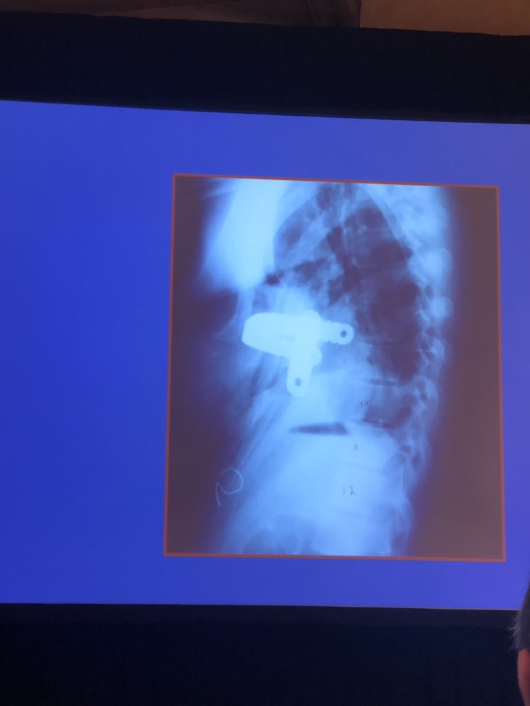 Always a treat to hear a surgical giant speak about an innovation. Dr Nuss shares the development of the Nuss procedure. #chestwallsurgery #pectusexcavatum