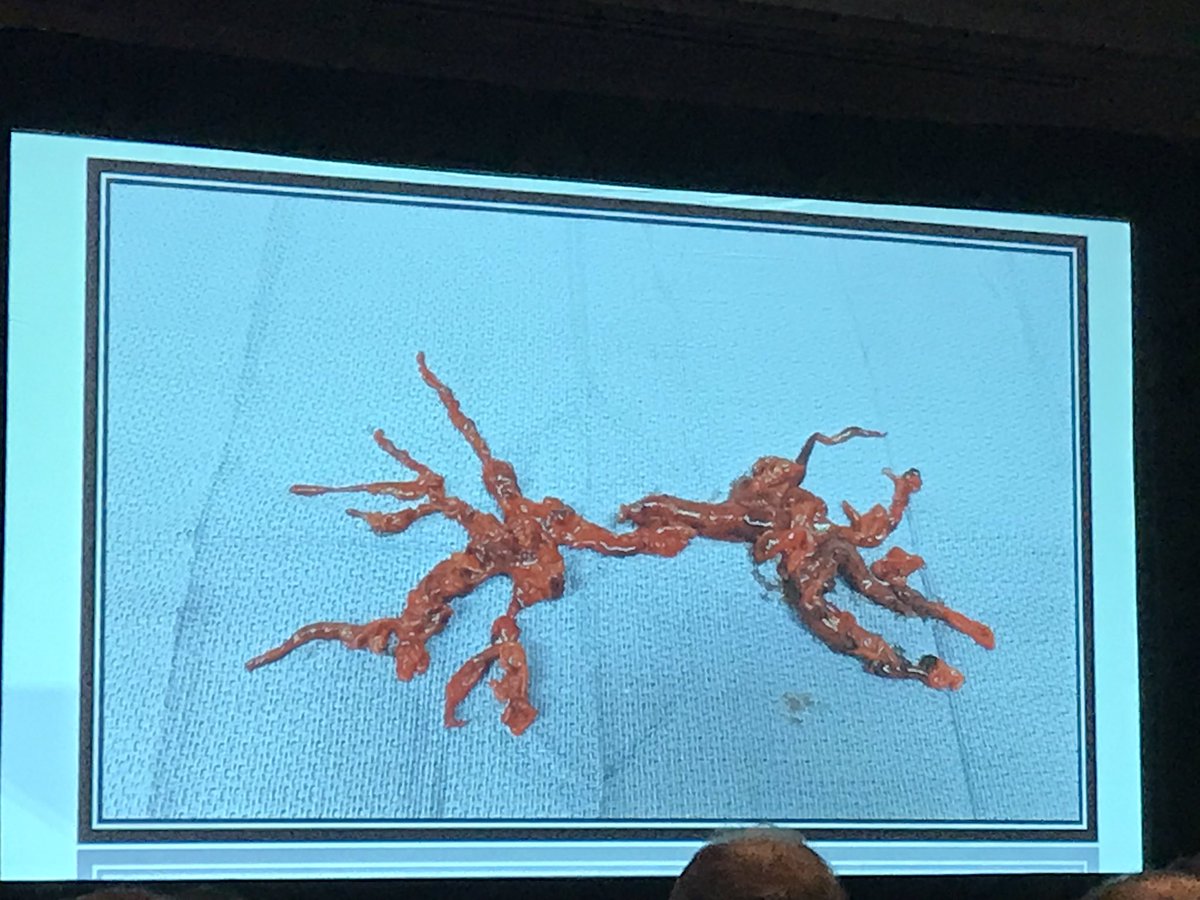 At Westchester medical they treat all massive PEs as a surgical disease- akin to type A dissection  Malekan wowing the crowd with incredible specimens and making a damn good argument