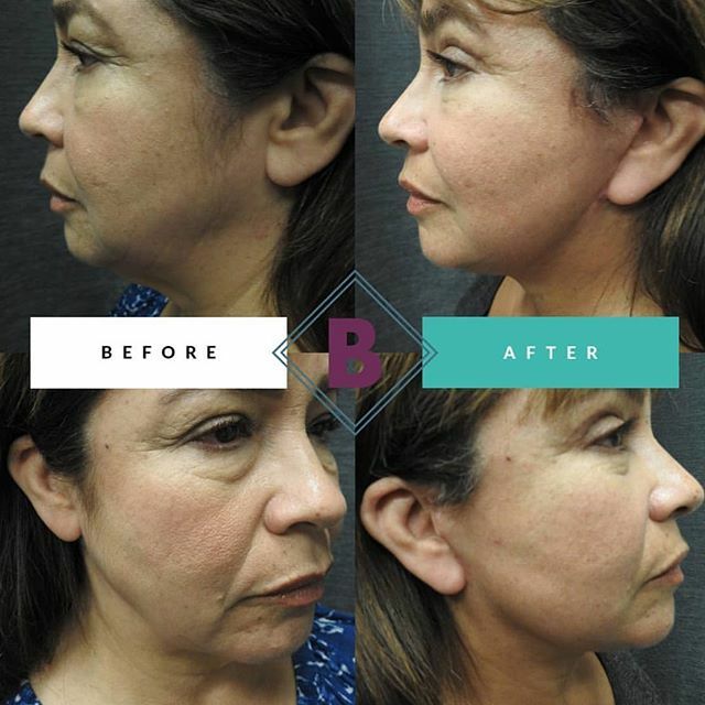 We’re lifting our way into the weekend with these #realresults of a #quicklift #facelift combined with dermal filler Revanesse Versa for our patient pictured here. After her QuickLift, her results are perfection, her confidence high, and together as a te… ift.tt/31N1q5K