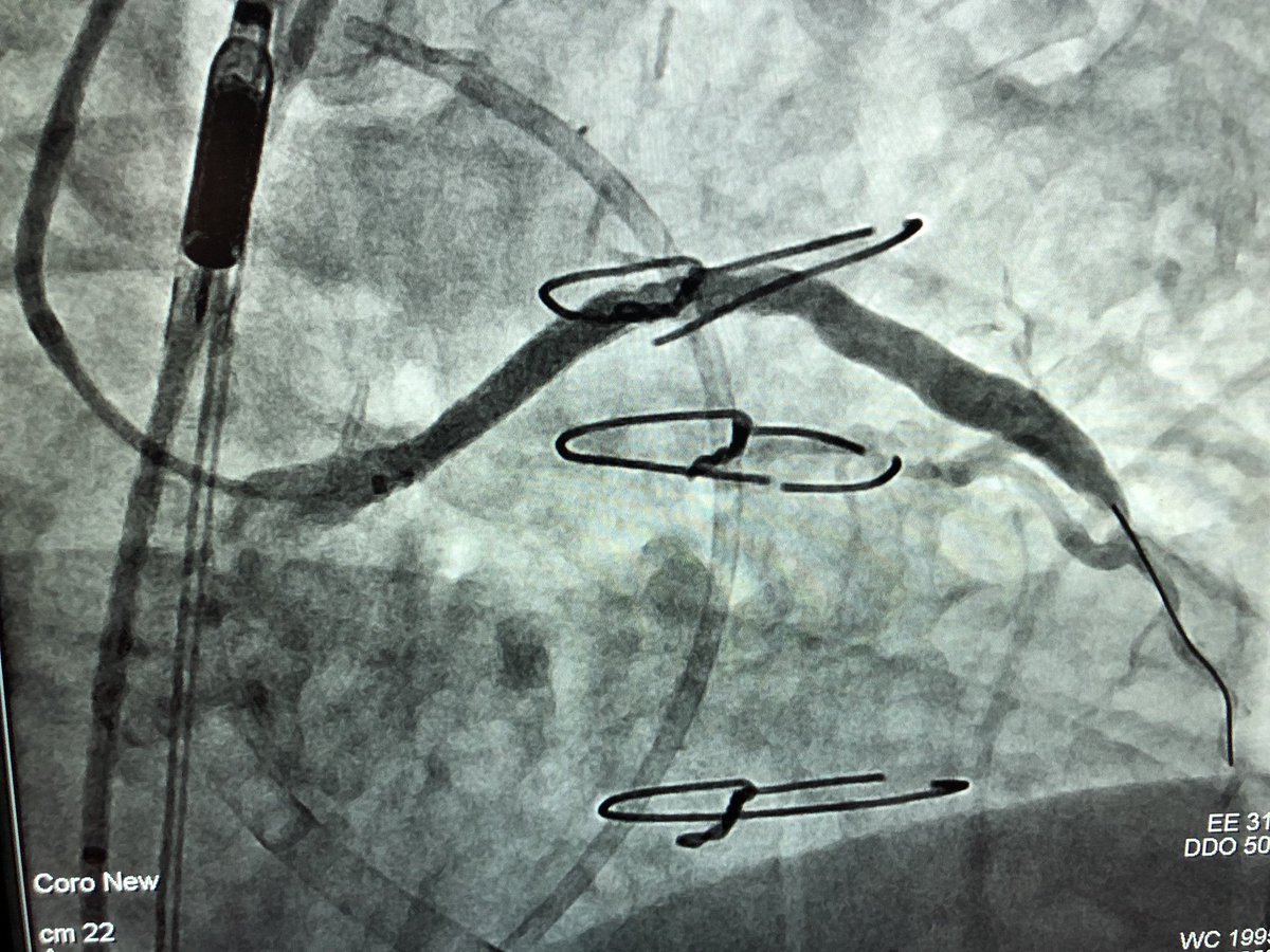 DrAmirKaki's tweet photo. Case today illustrates the value of MCS in preserved EF.  18 yo SVG to LAD also supplying collaterals to the RCA which was CTO.  High grade LM to Lcx.  During 🎈inflation of SVG loss of pulse pressure.  IVUS guided SVG and LM LCX successfully treated.  Preserved native LAD option https://t.co/rm8eR2KwuR