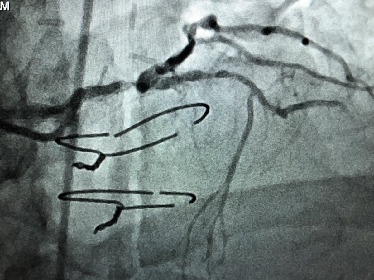DrAmirKaki's tweet photo. Case today illustrates the value of MCS in preserved EF.  18 yo SVG to LAD also supplying collaterals to the RCA which was CTO.  High grade LM to Lcx.  During 🎈inflation of SVG loss of pulse pressure.  IVUS guided SVG and LM LCX successfully treated.  Preserved native LAD option https://t.co/rm8eR2KwuR