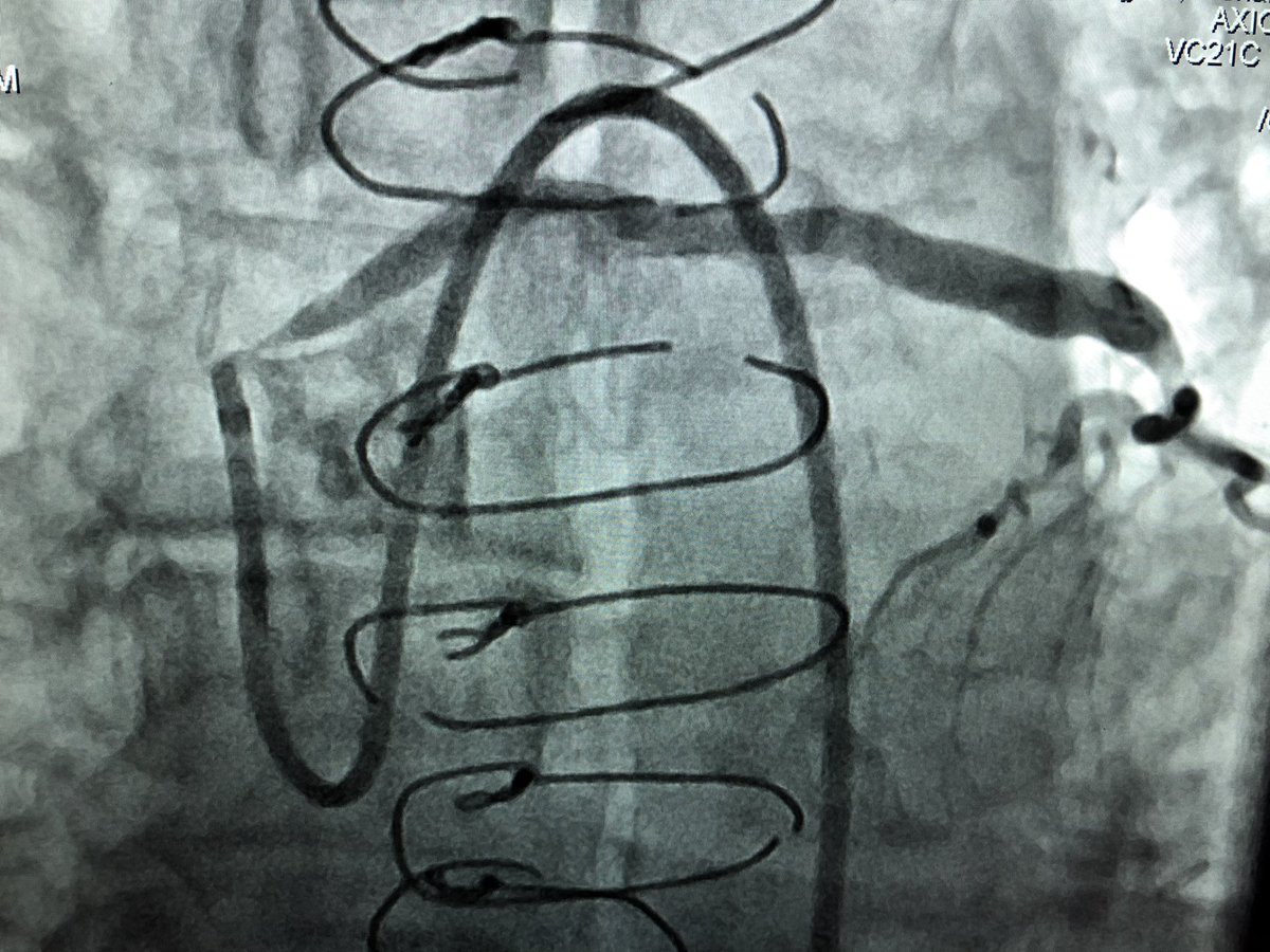 DrAmirKaki's tweet photo. Case today illustrates the value of MCS in preserved EF.  18 yo SVG to LAD also supplying collaterals to the RCA which was CTO.  High grade LM to Lcx.  During 🎈inflation of SVG loss of pulse pressure.  IVUS guided SVG and LM LCX successfully treated.  Preserved native LAD option https://t.co/rm8eR2KwuR