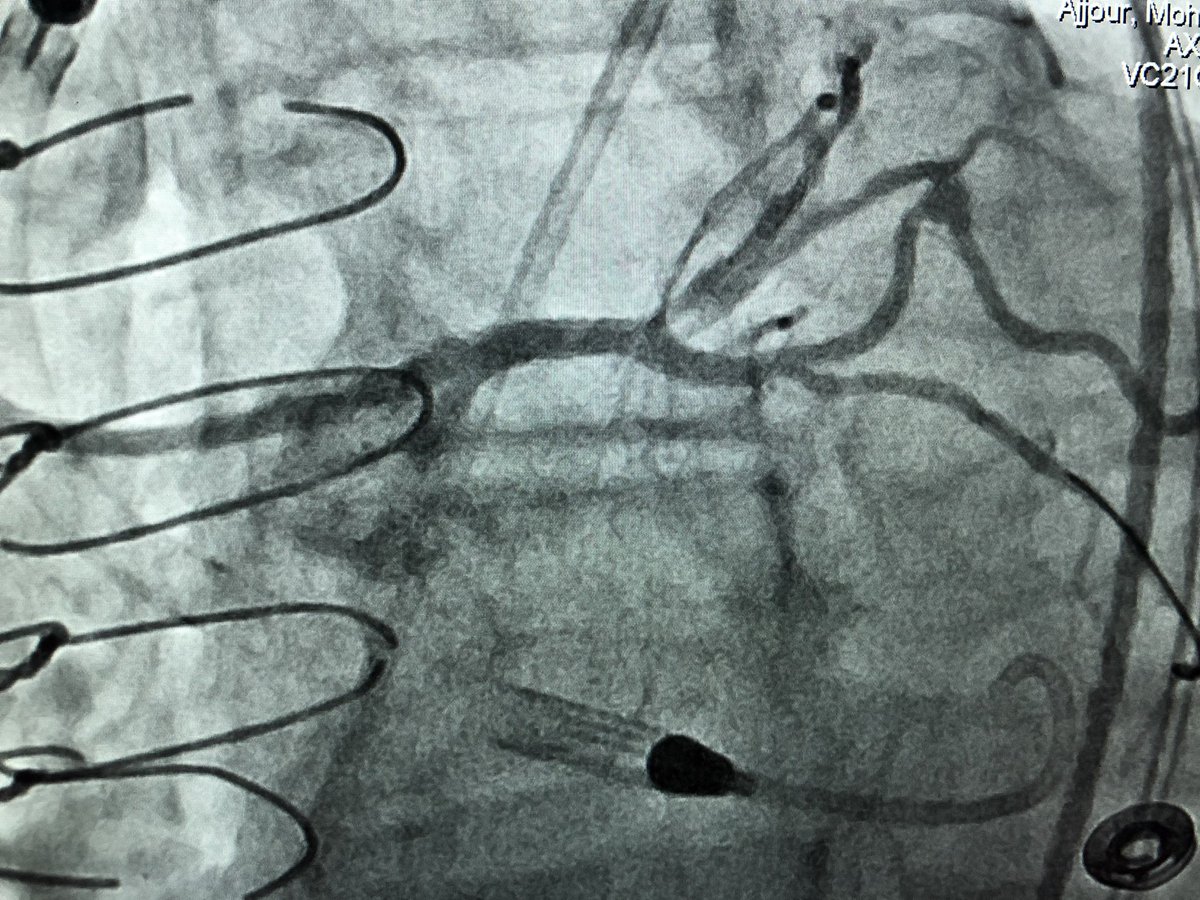 Case today illustrates the value of MCS in preserved EF.  18 yo SVG to LAD also supplying collaterals to the RCA which was CTO.  High grade LM to Lcx.  During 🎈inflation of SVG loss of pulse pressure.  IVUS guided SVG and LM LCX successfully treated.  Preserved native LAD option