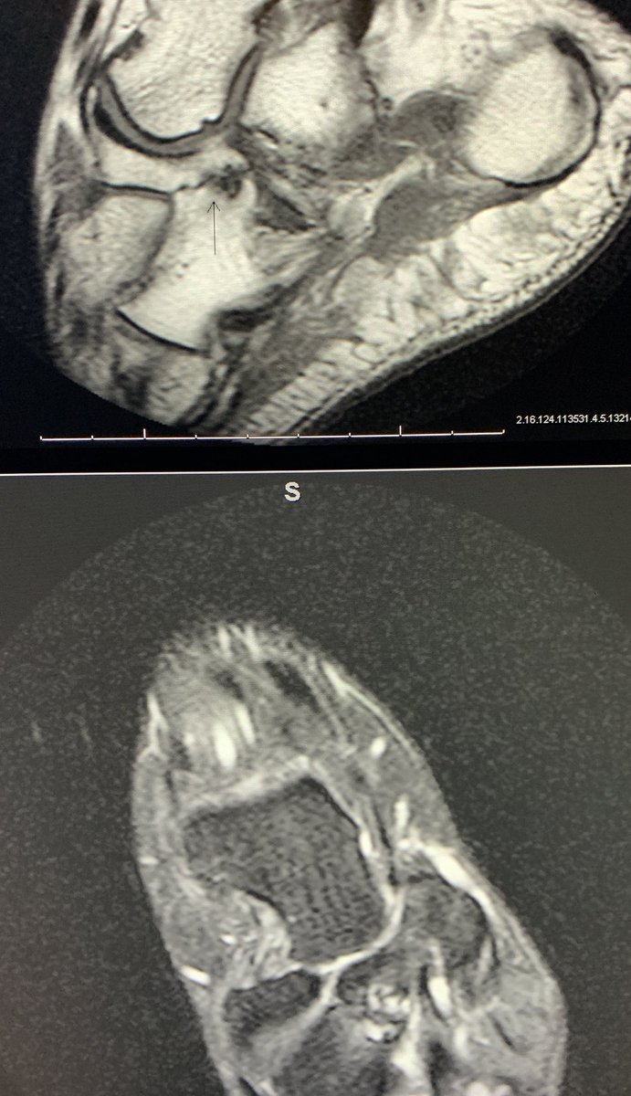 Why is the navicular-cuboid coalition so disrespected?  Respect the rigid hindfoot!!