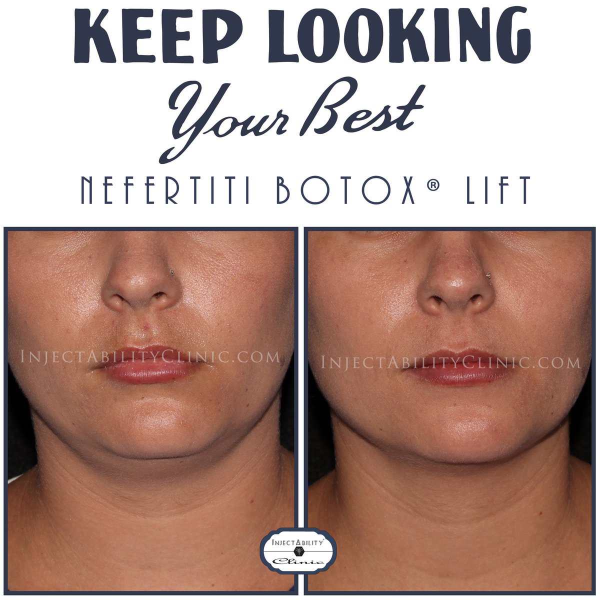 InjectAbility's tweet photo. Did you know #neurotoxins such as #botox #dysport or #jeuveau can be placed into the neck to create a tighter, more contoured jawline and give the face a little lift? The #Nefertiti lift is a technique commonly used at #InjectAbility to provide a lifting affect. https://t.co/7iRMOTQHeb