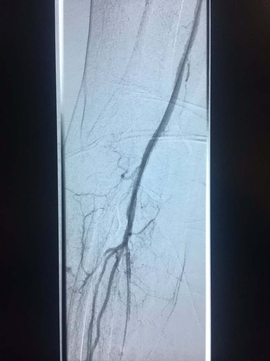 David Wells (@drdavidwellsir) on Twitter photo Traumatic occlusion of the distal Axillary artery of the dominant Rt arm due to # humerus. Ischaemic but viable arm. #radial access in a low volume but patent radial art. 6f sheath. #Bard Lifestream stent graft restores flow. #RadialFirst #trauma <a href="/UHNM_Imaging/">UHNM IMAGING</a> <a href="/profkader/">Kader Allouni</a> Traumatic occlusion of the distal Axillary artery of the dominant Rt arm due to # humerus. Ischaemic but viable arm. #radial access in a low volume but patent radial art. 6f sheath. #Bard Lifestream stent graft restores flow. #RadialFirst #trauma <a href="/UHNM_Imaging/">UHNM IMAGING</a> <a href="/profkader/">Kader Allouni</a>