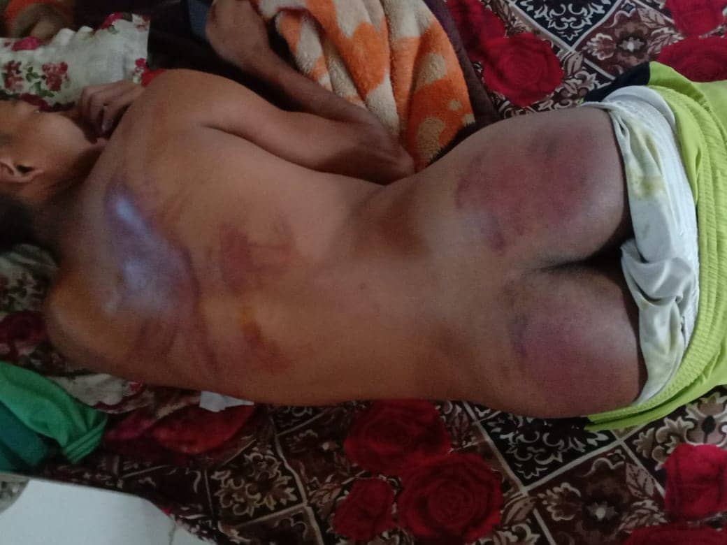 Paritosh Chakma on X: Chakma student tortured in JNV Thenzawl (See  photos). But police failed to register a case. Rvanlalsinga, in-charge at  the Thenzawl Police Station said “We have not registered any