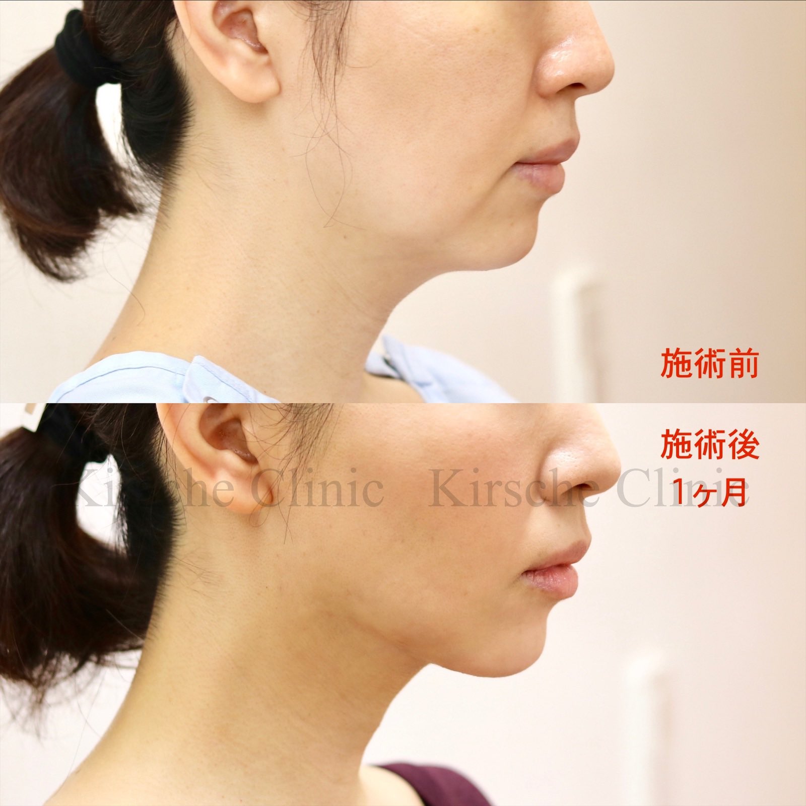 キルシェクリニック Dr めかた 40代の患者さん マリオネットラインが消えると10歳くらい若返った印象ですね フェイスラインもクッキリで小顔になり あご下もスッキリ良い感じ 脂肪吸引 顔痩せ 顔脂肪吸引 バッカルファット 小顔 脂肪吸引したい