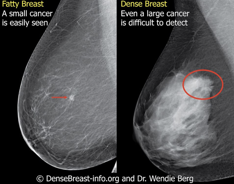 DenseBreastInfo's tweet photo. Thank you @grettamonahan for sharing your story in the interest of educating women. #DenseBreasts both hide cancer and increase a woman's risk. For the most comprehensive medically-sourced resource, please visit/share https://t.co/8h14LphGPb. #FindItSmall @TheView https://t.co/0jMol2W8sd