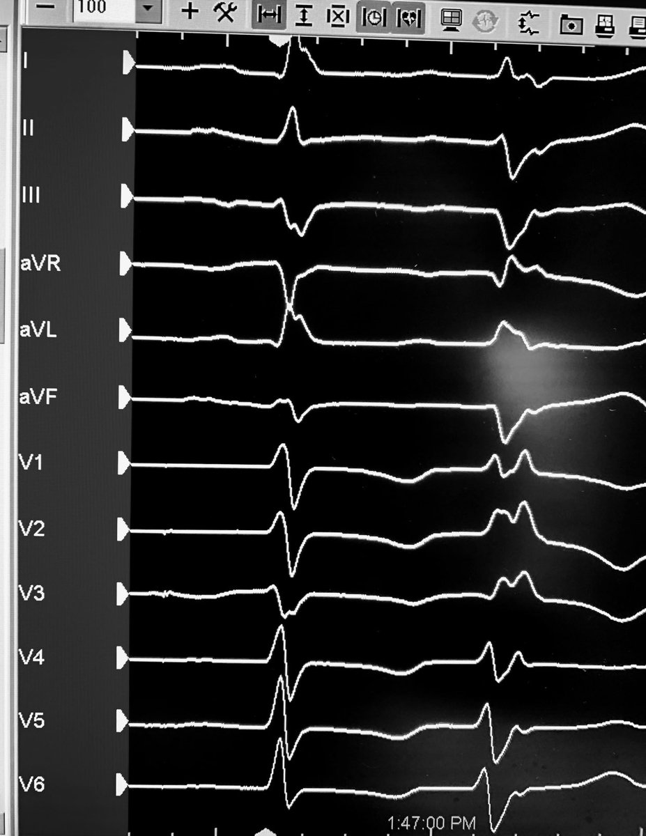 forkknifecab_EP's tweet photo. No #ICE required, #JustGrid for this LV posterior medial papillary muscle (45% burden, 30% EF, 48 y.o. pt.) PVC. 28 minute total (pre-waiting period) procedure time. Happy patient, happy family. #HDGrid #TactiCathSE #PDXtech @AbbottCardio @TheArtOf_EP @cschroede_EP https://t.co/V8Ezqnq1kG