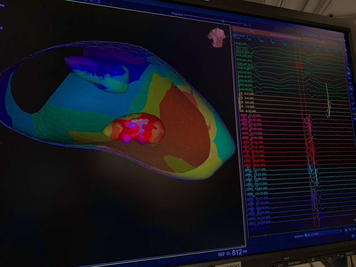 forkknifecab_EP's tweet photo. No #ICE required, #JustGrid for this LV posterior medial papillary muscle (45% burden, 30% EF, 48 y.o. pt.) PVC. 28 minute total (pre-waiting period) procedure time. Happy patient, happy family. #HDGrid #TactiCathSE #PDXtech @AbbottCardio @TheArtOf_EP @cschroede_EP https://t.co/V8Ezqnq1kG