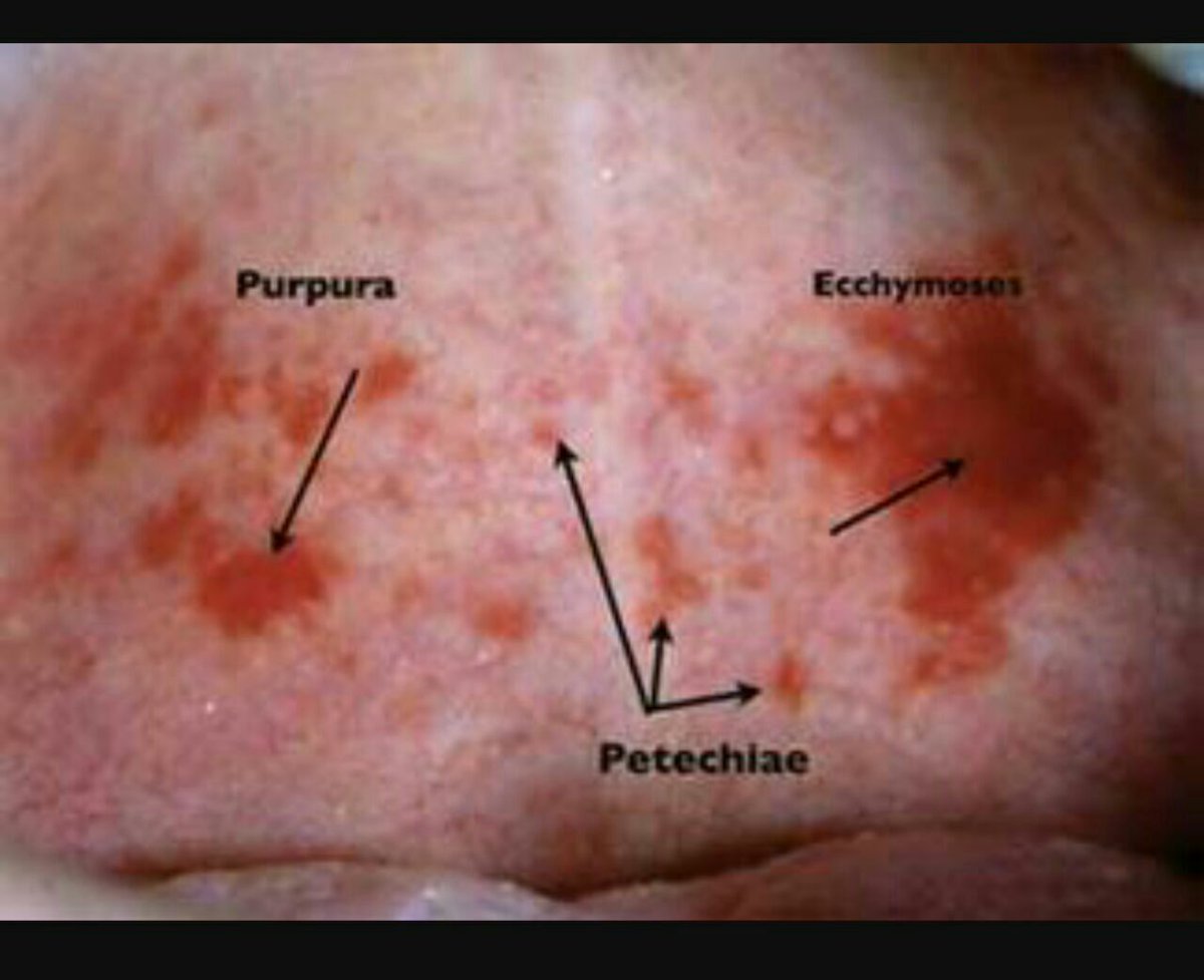 pgMedicine's tweet photo. #Purpura 🆚️ #petechiae 🆚️ #ecchymoses 

#foamed #medEd #medtwitter #mrcp #usmle #fcps #plab #dermatology #Physician #Medical #physical #exam #hematology https://t.co/hTRvRowGnG