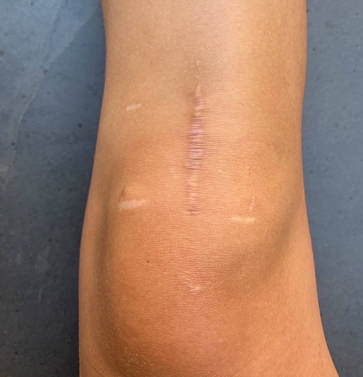 jojocotto's tweet photo. one year ago today I had my second acl surgery! it’s been the hardest thing I’ve ever done but I’ve grown so much. couldn’t have done it without the amazing support of my family, friends, and team❤️. never give up on your dreams, it’s worth it!! #stablemabel #comebackszn 🦵⚽️ https://t.co/5hQwMfNlwh
