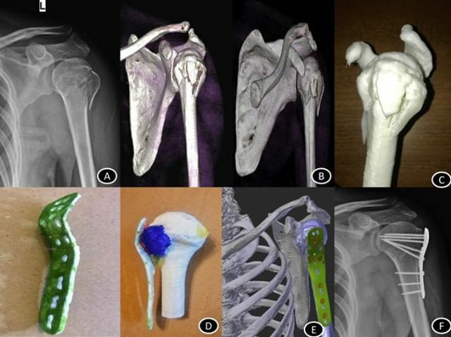 3dheals's tweet image. 3D printing for preoperative management of complex orthopedic cases @3DPrint_com #3dprinting #medicalmodels #technology #additivemanufacturing #orthopedicsurgery #preoperativetraining #treatment #healthcare #Virtualpreoperativeplanning #JointheTribe … ift.tt/2IroxLw