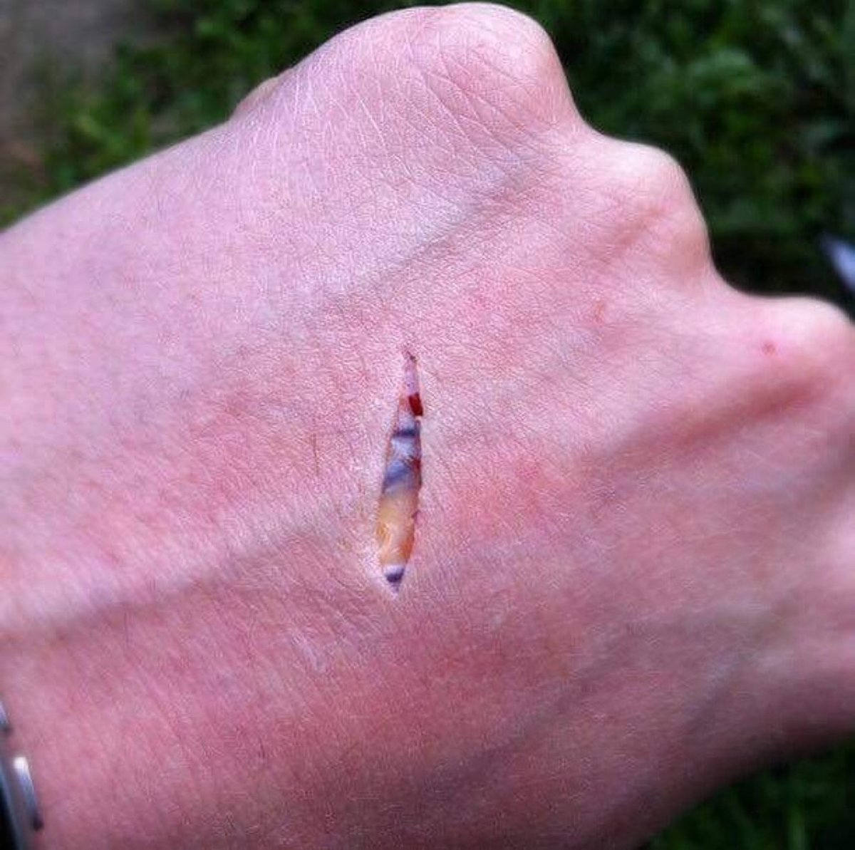 GiaPratamaMD's tweet photo. Clean cut, no blood. https://t.co/Um6rt1d71q
