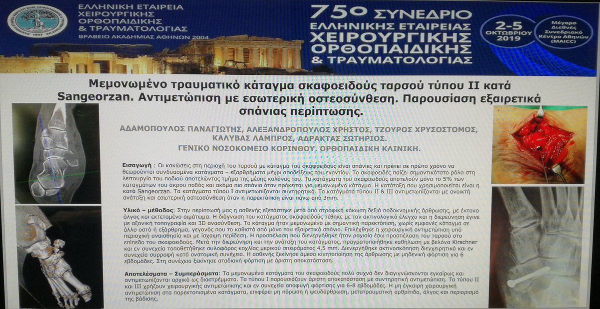 _adamopoulos's tweet photo. Μεμονωμένο τραυματικό κάταγμα σκαφοειδούς ταρσού τύπου ΙΙ κατά Sangeorzan.  Αντιμετώπιση με εσωτερική οστεοσύνθεση. Παρουσίαση εξαιρετικά σπάνιας περίπτωσης. https://t.co/eQcpCNpvgb
