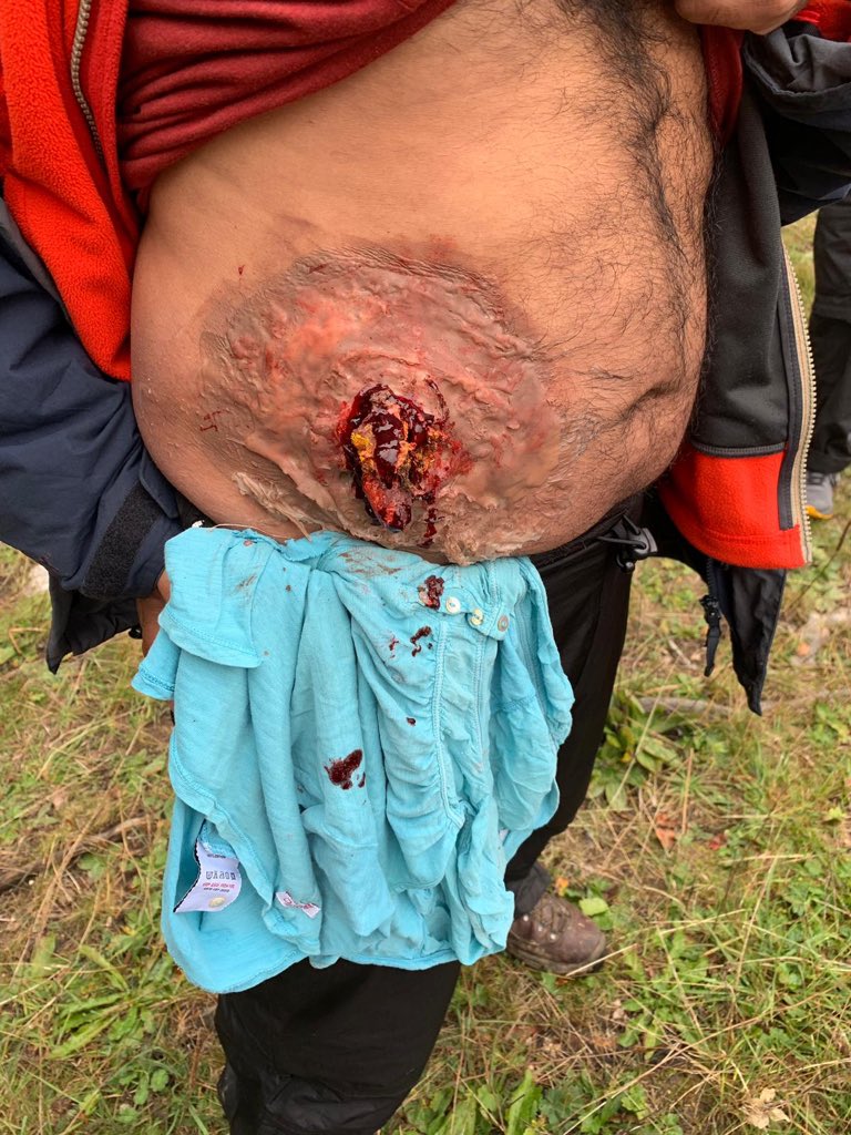 DrJazBahra's tweet photo. The last day of walking with all the makeup... @FarawayMedicine offers such high fidelity sim in austere and outdoor environments #simulation #highfidelitysim #makeup #siliconeskills #ouch https://t.co/OwAy2R82FA