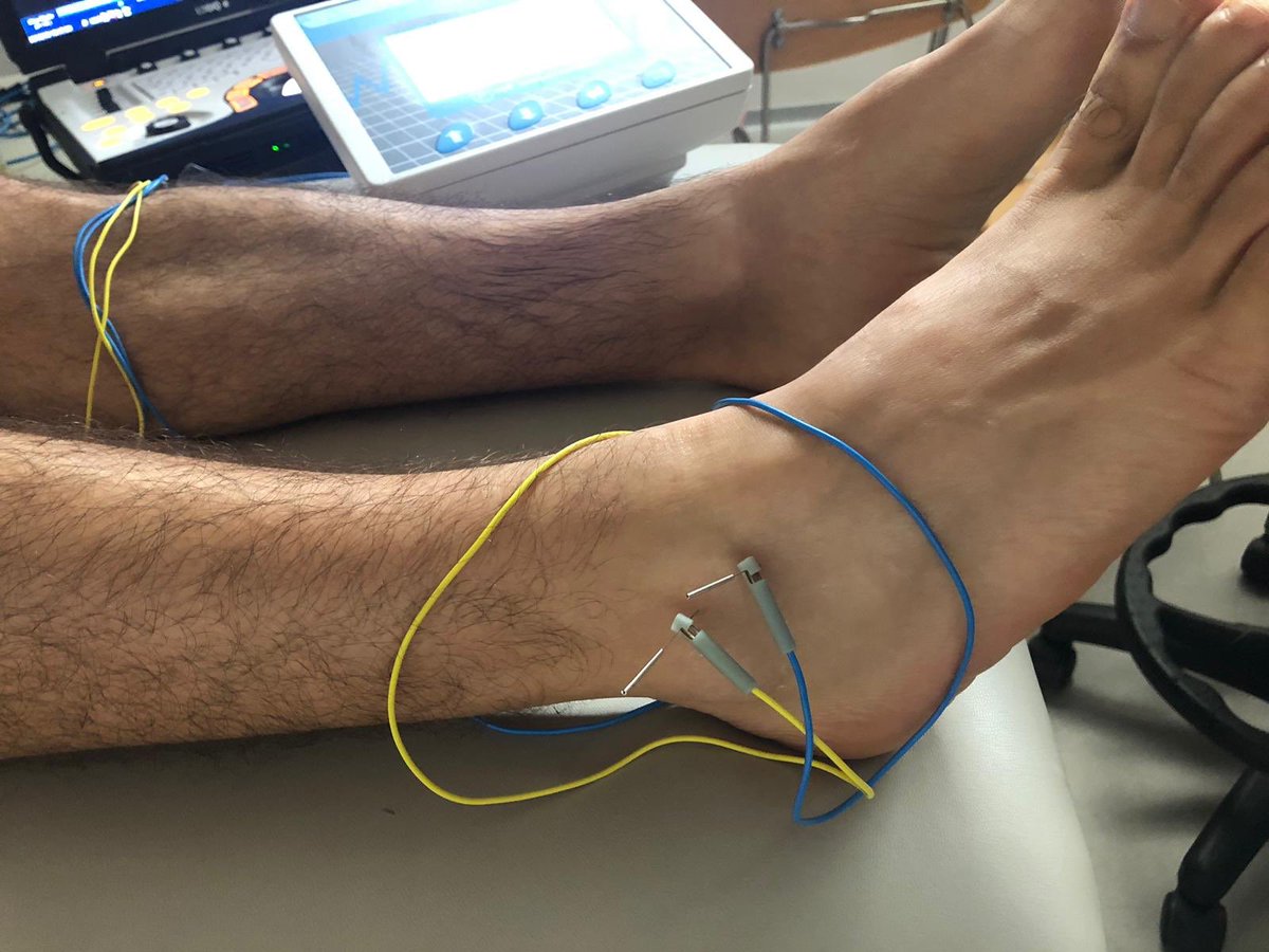 Caso clínico en el <a href="/MOFI_FT_PT/">Máster FT Invasiva Portugal</a>
Impingement anterolateral tobillo. Aplicación <a href="/ElectrolisisP/">Electr. Percutánea</a> receso + <a href="/NeuroMPercut/">NeuroMPercutanea</a> ligamento interóseo. Razonamiento clínico!!! #Seguimosavanzando <a href="/MVClinic/">MVClinic Institute</a>