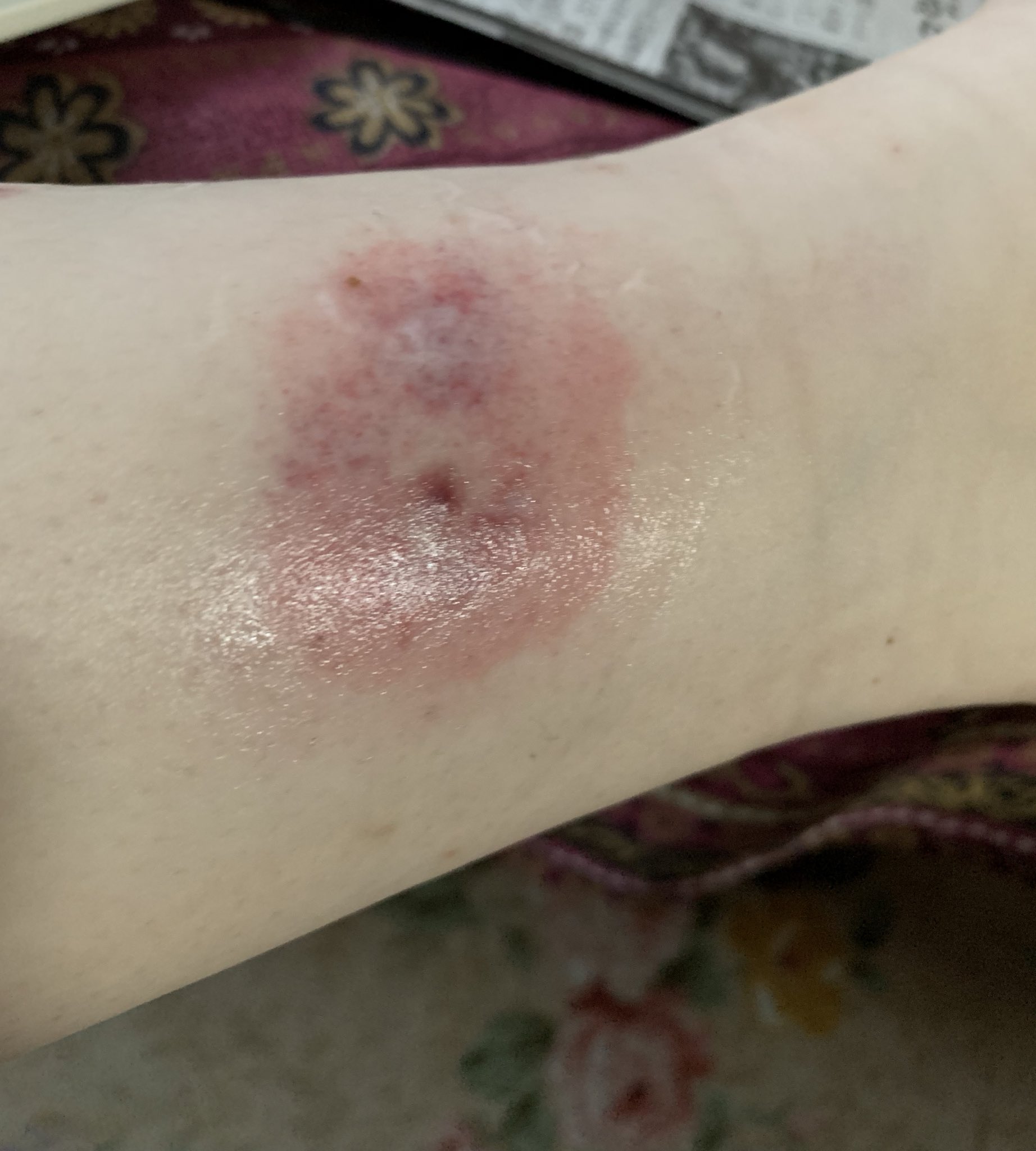 りこぴん 虫刺されが痒かったので ノミ ダニだと思って皮膚科を受診 ネコ買っているので 痒み止め服用 塗り薬使用で痒みは治りましたが 次の日めちゃくちゃ腫れてます これ何が原因かわかりますか りこぴん 虫刺されが痒かったので ノミ ダニだと思って皮膚科を受診 ネコ買っているので 痒み止め服用 塗り薬使用で痒みは治りましたが 次の日めちゃくちゃ腫れてます これ何が原因かわかりますか