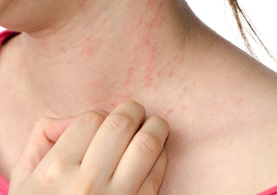 hormonedietdoc's tweet photo. I never see skin problems in patients like Eczema, Psoriasis, Rosacea or Keratosis Pilaris without a connection to the gut &amp; permeability of the gut wall. If you suffer one of these try a diet of meat, eggs &amp; fish and take L-Glutamine to restore the G.I. tract from leaky gut https://t.co/Ox1ah4EMSg