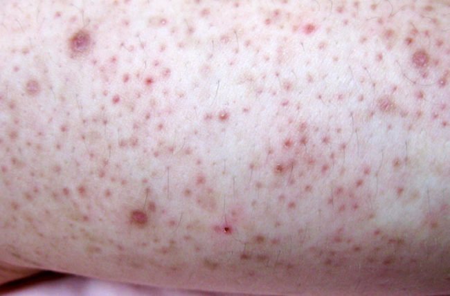 hormonedietdoc's tweet photo. I never see skin problems in patients like Eczema, Psoriasis, Rosacea or Keratosis Pilaris without a connection to the gut &amp; permeability of the gut wall. If you suffer one of these try a diet of meat, eggs &amp; fish and take L-Glutamine to restore the G.I. tract from leaky gut https://t.co/Ox1ah4EMSg