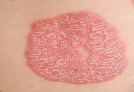 hormonedietdoc's tweet photo. I never see skin problems in patients like Eczema, Psoriasis, Rosacea or Keratosis Pilaris without a connection to the gut &amp; permeability of the gut wall. If you suffer one of these try a diet of meat, eggs &amp; fish and take L-Glutamine to restore the G.I. tract from leaky gut https://t.co/Ox1ah4EMSg
