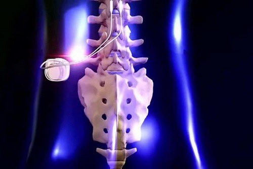 urovelay's tweet photo. @MedtronicFR UroVelay propose bientôt la neuromodulation des racines sacrées pour les patients intéressés! https://t.co/7AIsNnTEd1