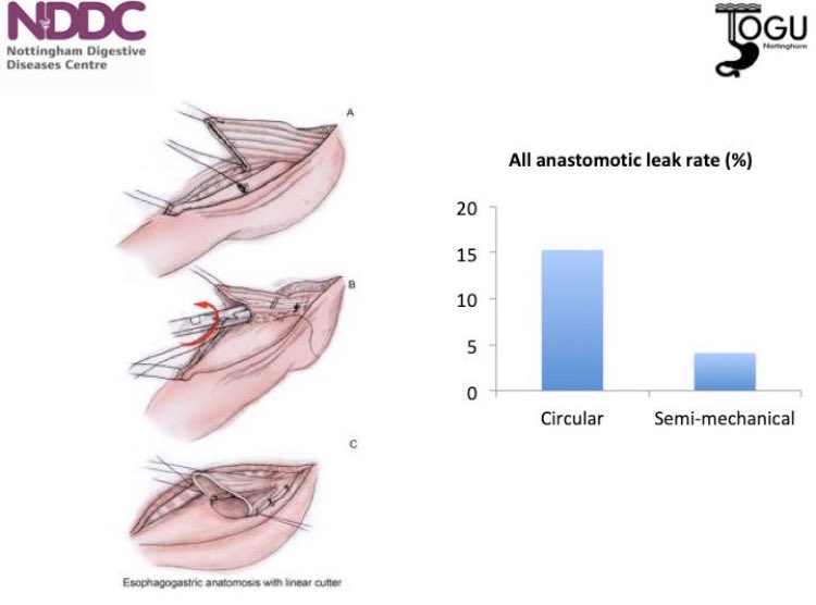 Ravinder Vohra (@ravi__vohra) on Twitter photo Great to see this paper now in <a href="/WorldJSurg/">World Journal of Surgery</a>. By standardising anastomotic technique in the unit during #oesophagectomy for #oesophageal #cancer, we âŹď¸ our leak rate by 73%. Suspect unit standardisation is more important than actual anastomotic technique link.springer.com/article/10.100⌠Great to see this paper now in <a href="/WorldJSurg/">World Journal of Surgery</a>. By standardising anastomotic technique in the unit during #oesophagectomy for #oesophageal #cancer, we âŹď¸ our leak rate by 73%. Suspect unit standardisation is more important than actual anastomotic technique link.springer.com/article/10.100âŚ