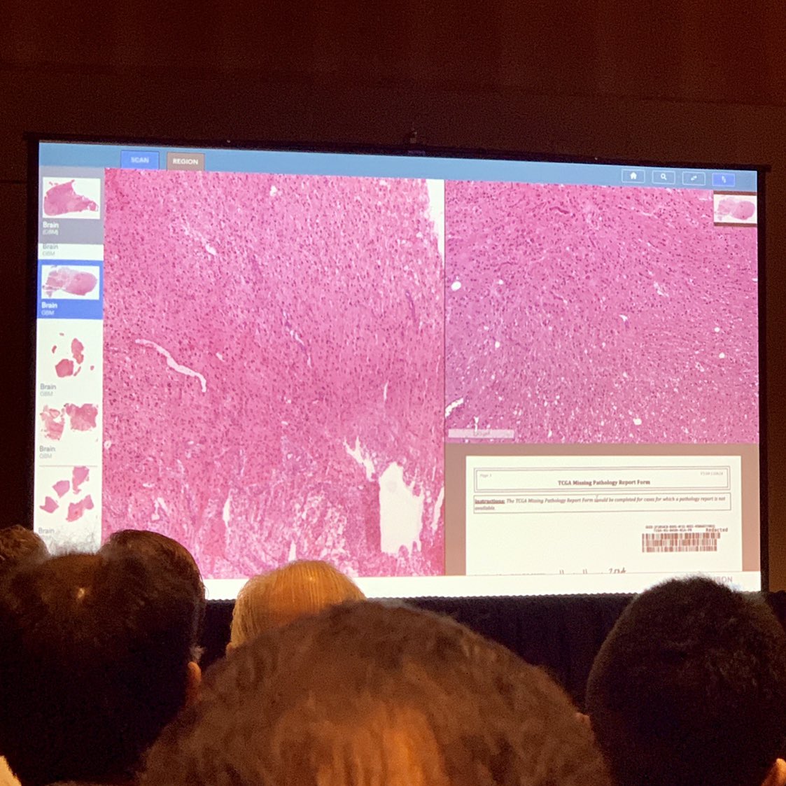 gtevaristomd's tweet photo. So what if you could input your digital slide to search for matching histopath features &amp; associated pathology report findings? 🤔  
@hurondp @HamidRTizhoosh  @KIMIA_Lab Getting us all excited about WSI Image Search here at #PathVisions19 👏🏾 #AI #digitalpathology https://t.co/0ONzQENZhN