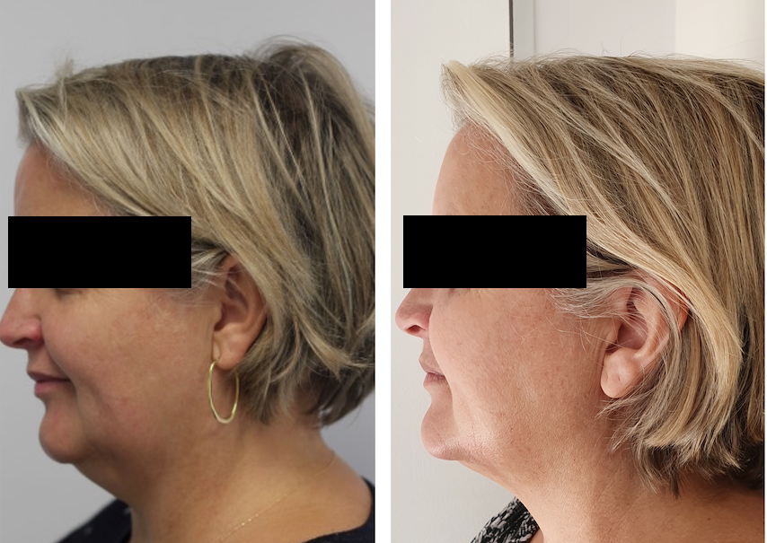 The power of submental fat dissolving injections.
This result was achieved after only one treatment, performed in our Sandringham rooms by Dr Sara Tarafi. #fatdissolving #nonsurgical #doublechintreatment #CosmeticDoctors #BaysideCosmetics