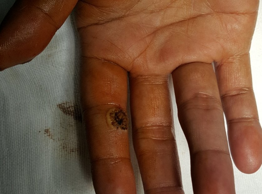 JBSANTOSMD2's tweet photo. For #verrucae #hpv warts of the hands...we cauterize and debride after 24 hours to avoid bleeding...
@jrgmendoza94
@CouragePinas
@iamfivefootsix https://t.co/dFerLICARV