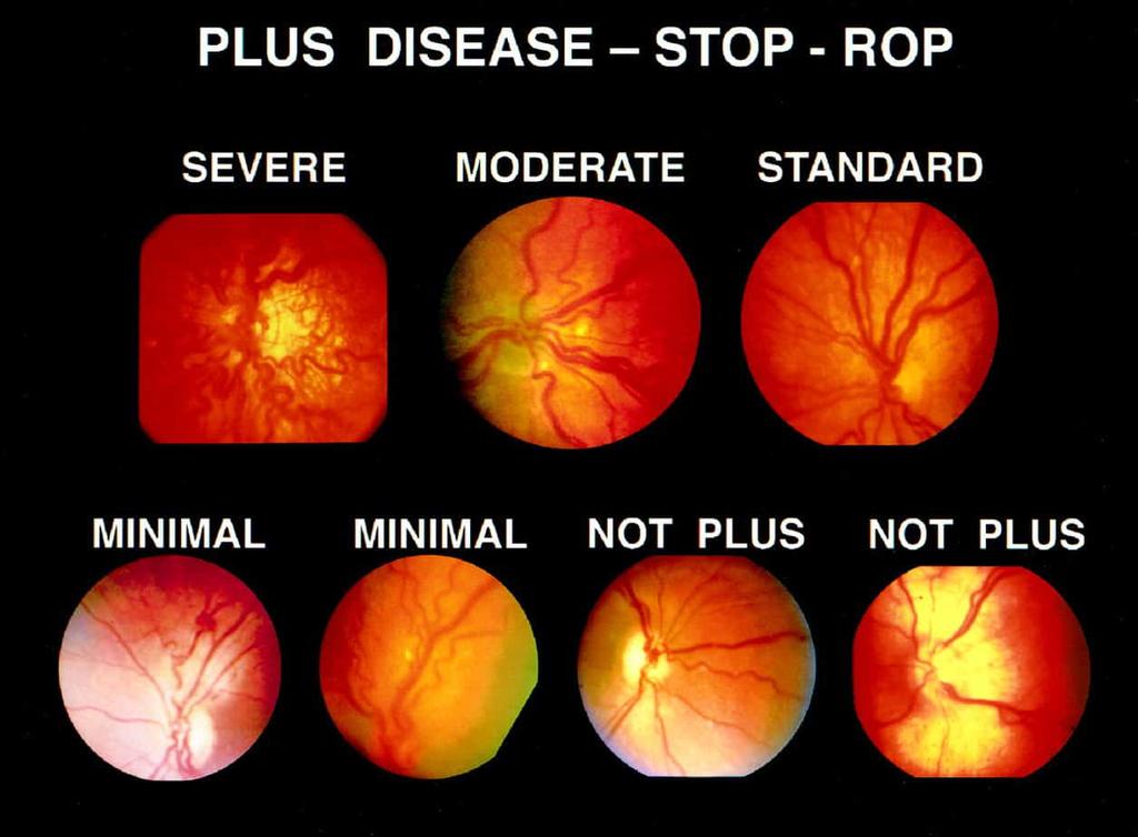 mazhry's tweet photo. "Treatment depends on the stage of ROP." https://t.co/GSh6rwPEEv #RetinopathyofPrematurity #prematurity #ROP #ROPscreening https://t.co/KhGpVlrdVI