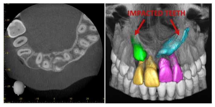 Impacted teeth: On occasion teeth can become stuck under the gum and buried in the bone. A special scan (CBCT) is taken to locate the tooth’s position and help us plan what to do with these teeth. #CLAPA #CleftAware #ImpactedTeeth #CBCT #BOS #Orthodontics #SwanseaBay