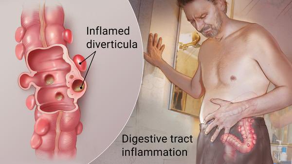 Antibiótico para el colon inflamado