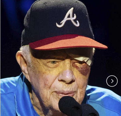 Mkapub's tweet photo. Ex-President Jimmy Carter has black eye, stitches after fall: https://t.co/9hVbyZYMYd https://t.co/b8T1KXtmug