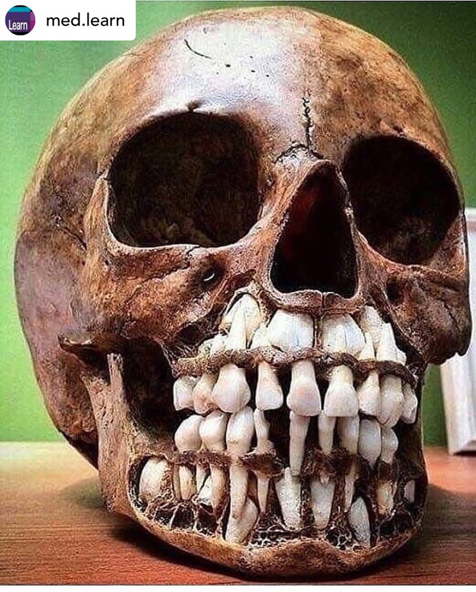 PasionAnatomia's tweet photo. Cráneo de un niño donde se puede apreciar la dentición decidua y permanente. https://t.co/u88ts0E8Kp