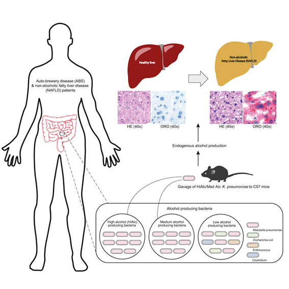 El Síndrome de la auto-cervecería (Auto-brewery syndrome) puede ser una de las causas de #enfermedad hepática por hígado graso no alcohólico. Algunas bacterias de nuestra #microbiota fermentan azúcares a alcohol en cantidad suficiente para emborracharnos!
bit.ly/2opcWpt