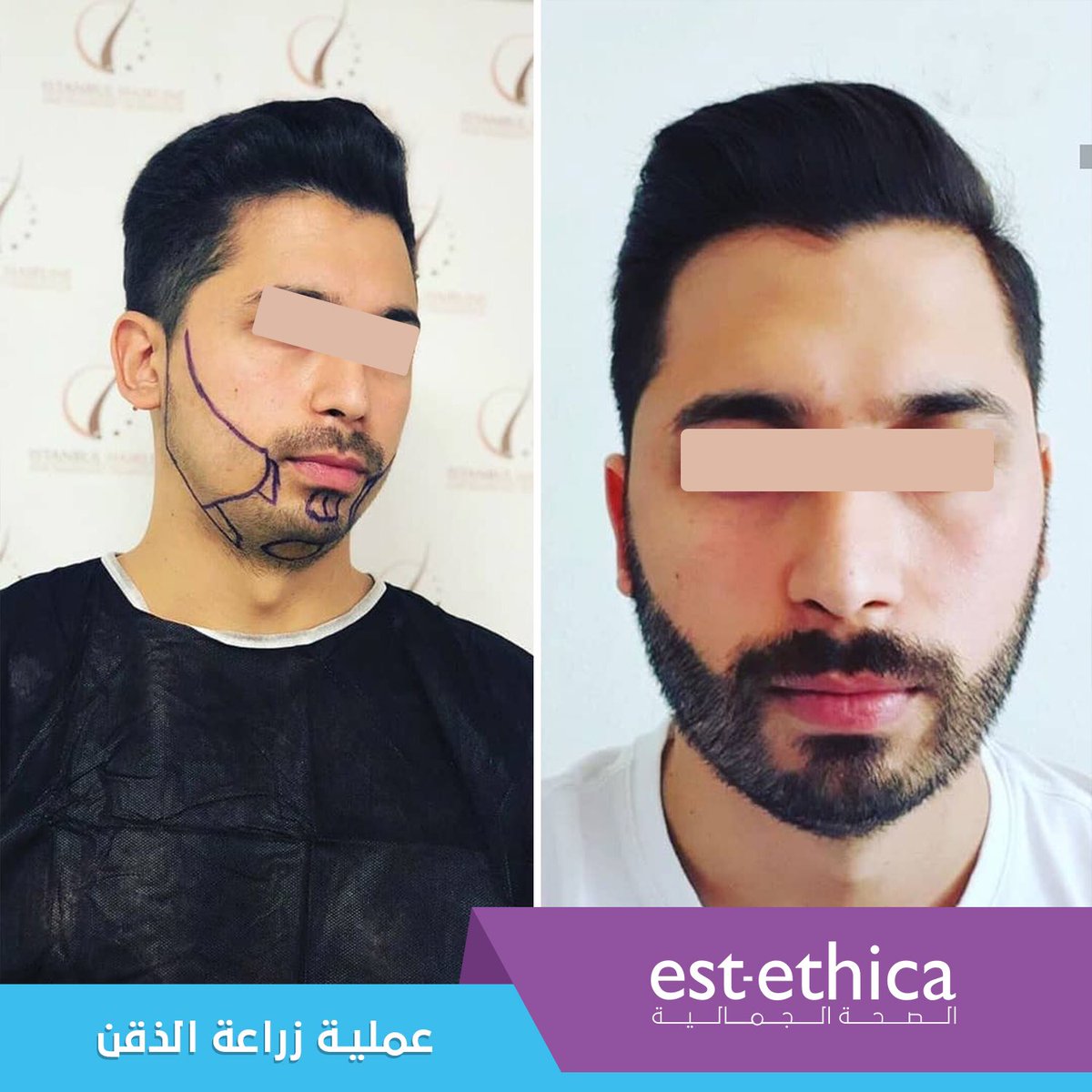 mediogluar's tweet photo. نتاءج عملية زراعة لحية في مجموعة شمافي ايست ايثيكا
#زراعة_شعر_اللحية #زراعة_شعر #بيركوتان #اقتطاف #عملية_زراعة_شعر #اف_يو_اي #تقنية_البيركوتان #لحية #ذقن #estethica #hairtransplant #beardtransplant https://t.co/ToUcSKxeJJ
