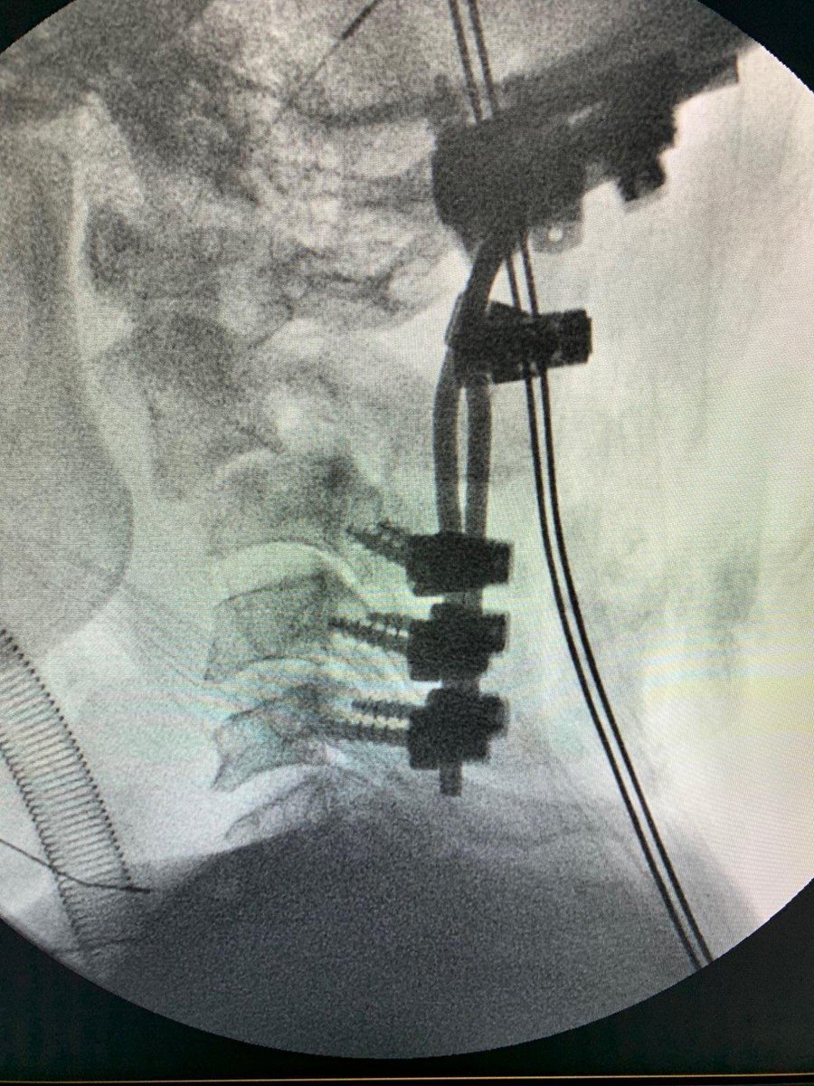 CMI_missions's tweet photo. Mozambican man blessed with a new beginning after surviving near decapitation. Last week during our campaign at Hospital Central de Maputo, our CMI team, working together with hospital staff, performed an unprecedented surgical procedure which gives the man a 2nd chance at life. https://t.co/KmM2rTQUTR