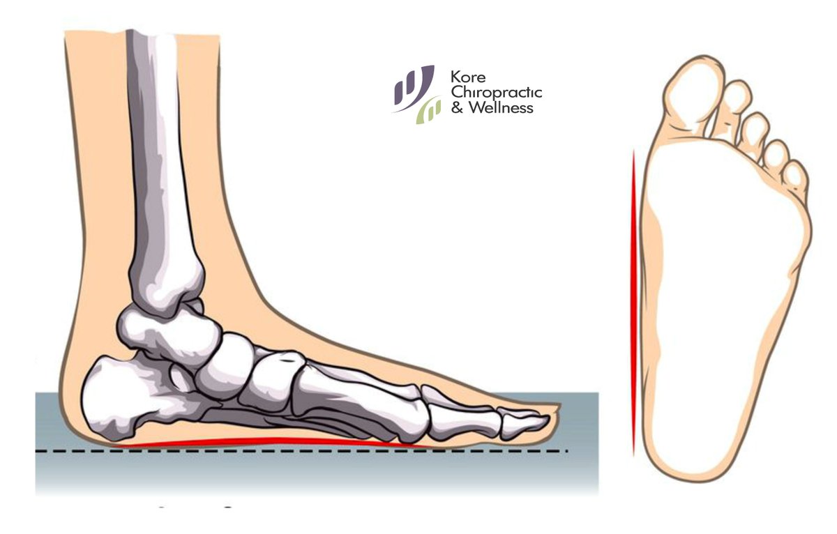 DrEdwardKo's tweet photo. The most obvious symptom of #overpronation is flattened foot arches. π£
While many people with #FlatFeet do not exhibit any noticeable symptoms... https://t.co/ObzntZoSPa @KoreChiro
π #CustomFootOrthotic #CustomFootOrthotics
π #CustomOrthotic #CustomOrthotics https://t.co/nuZrskHG4f